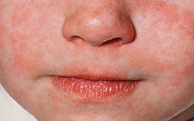 Tymai plinta. Sustabdyti gali tik skiepai